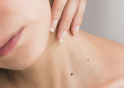 Skin Tags Removal Treatment