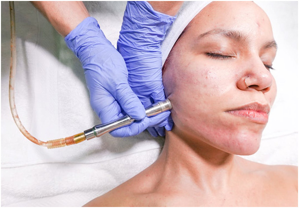 laser skin tightening